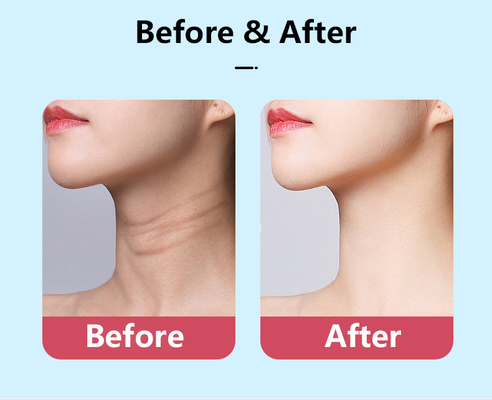 Équipement d'élimination des rides en acier inoxydable ABS pour le lifting facial du cou